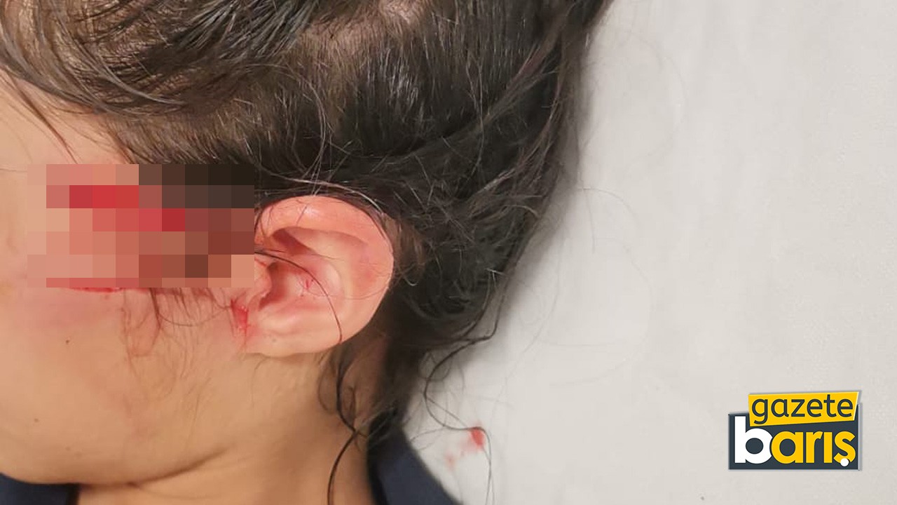 Kocaeli’de 8 yaşındaki çocuğuna köpek saldırısı: Baba isyan etti!