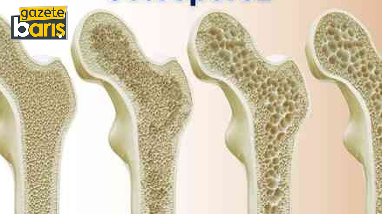 Osteoporoz, yaşam kalitesini olumsuz etkileyen ancak önlenebilir bir hastalıktır