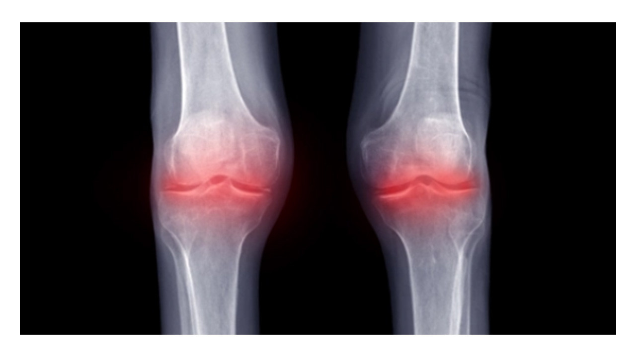 Kireçlenmeye karşı eksozom tedavisi yaygınlaşıyor