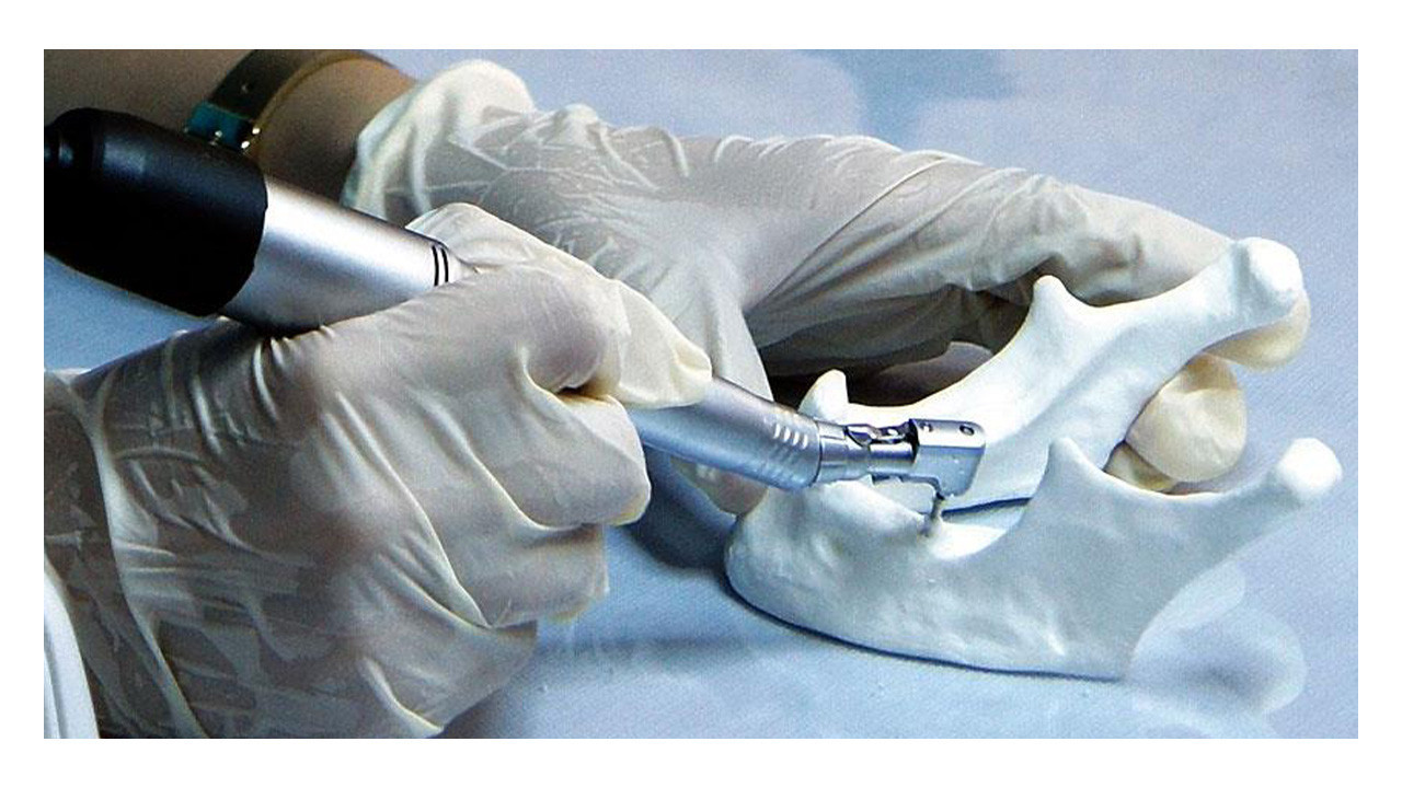 Vatandaşa diş müjdesi: SGK implant tedavisini karşılayacak!