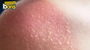 Güneş yanıklarına dikkat