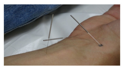 Akupunktur tedavisiyle sağlıklarına kavuştular