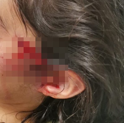 Kocaeli’de 8 yaşındaki çocuğuna köpek saldırısı: Baba isyan etti!