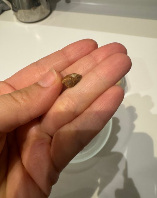 İçinden çıkan cisim Kocaelili vatandaşın dişini kırıyordu