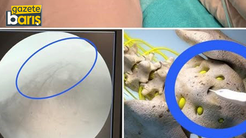 Epiduroskopi ile ameliyatsız tedavi