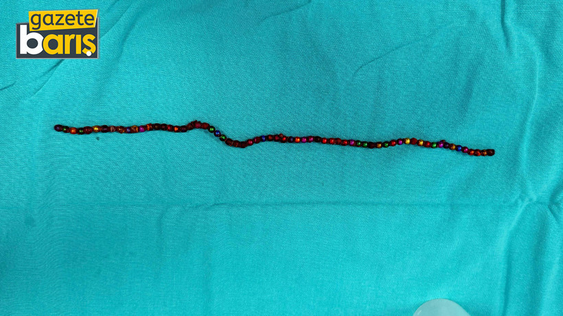 Doktorları bile şoke eden vaka: Karnında 66 adet mıknatısla aylarca hayatta kaldı