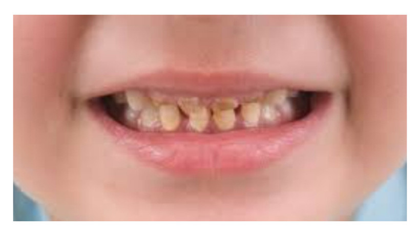 "Çocukların büyük kısmı yaşamının bir döneminde çürük ile karşılaşıyor"